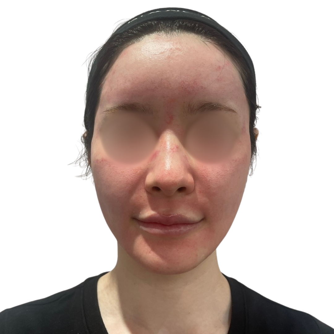 エクソソームフェイシャル